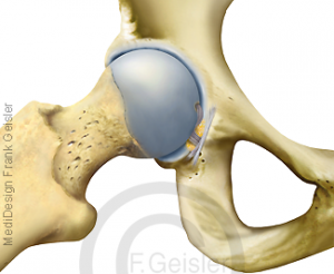 Coxarthrose H Ftgelenk