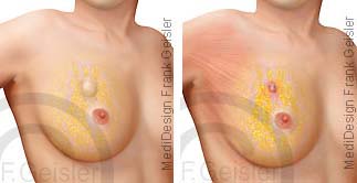 Brust Brustdrüse mit Knoten Fibroadenom und Brustkrebs Mammakarzinom