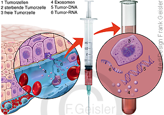Diagnostik Krebs, Tumorzellen im Blut