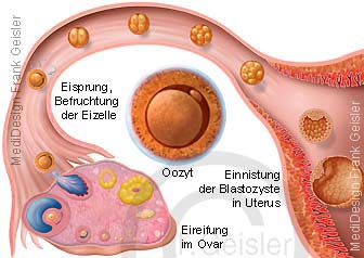 Befruchtung Eizelle Oozyt, Zellteilung und Einnistung Blastozyste in Gebärmutter Uterus