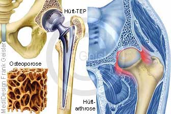 Endoprothese Hüftprothese Hueftgelenk wegen Osteoporose sowie Coxarthrose