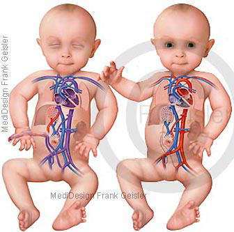 Herz Fetus und Baby, fetaler und postnataler Kreislauf Blutkreislauf