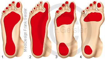 Fußsohle vom Fuß, Auflagen mit Fußfehlstellung Fußveränderungen bei Erkrankung Fuß