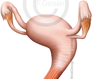 Geschlechtsorgan Gebärmutter Uterus mit Eileiter Eierstock Ovar der Frau