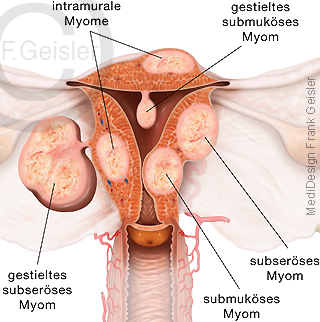Krankheit Gebärmutter Uterus, Myome Uterus-myomatosus