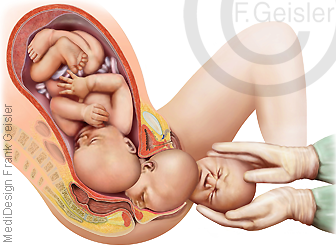 Schwangerschaft und Geburt Kind, Geburtskanal mit Fetus Fötus