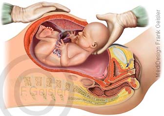 Geburt Kind durch Kaiserschnitt Schnittentbindung Sectio caesarea