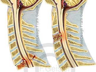 Fraktur Halwirbelsäule, Schädigung Verletzung Rückenmark Medulla spinalis