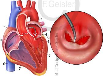 Erkrankung Herz, Mitralinsuffizienz und MitraClip der Herzklappe