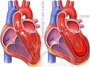 Herzschmerz, TakoTsuboKardiomyopathie