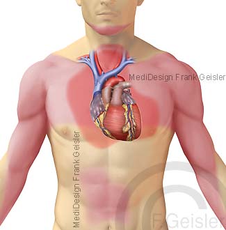 Erkrankung Herz Herzerkrankung Schmerzzone Herzschmerz bei Angina pectoris