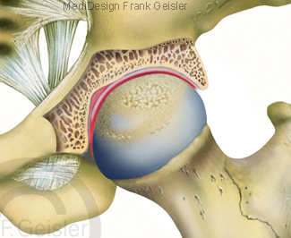 Becken mit Oberschenkelknochen Femur, Hüftgelenk Hüftgelenksarthrose Arthrose