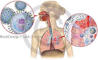 Influenza, Erkrankung der Atemwege der Lunge dirch Grippe Grippeviren Viren Influenzaviren