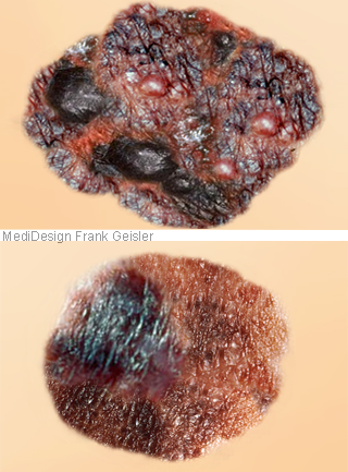 Krebs Hautkrebs malignes Melanom der Haut