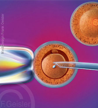 Künstliche Befruchtung Frau, In-vitro-Fertilisation IVF Eizelle Oozyte