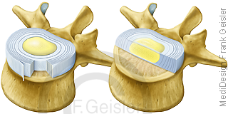 Anatomie Wirbel Wirbelkoerper mit Fasern der Bandscheibe Discus intervertebralis