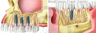 Zahnimplantation Zähne, Zahnimplantate Oberkiefer und Unterkiefer