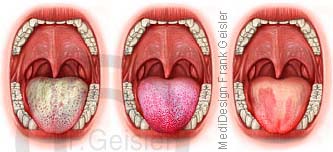 Dianose Zungenbelag der Zunge mit TCM-Zungendiagnostik zum Erkennen von Krankheiten