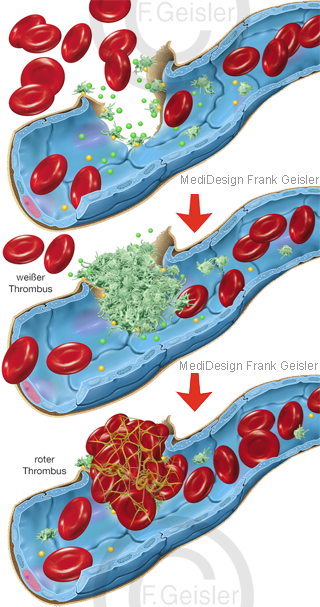 Blut Gerinnung Blutgerinnung Thrombenbildung und primäre sekundäre Hämostase